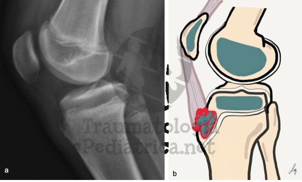 Osteocondrosis