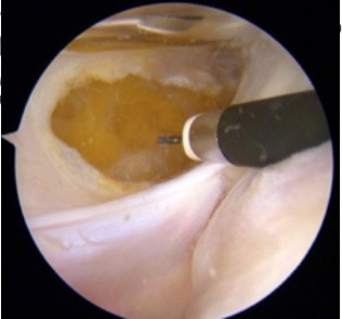 Intervención quirurgica de rodilla